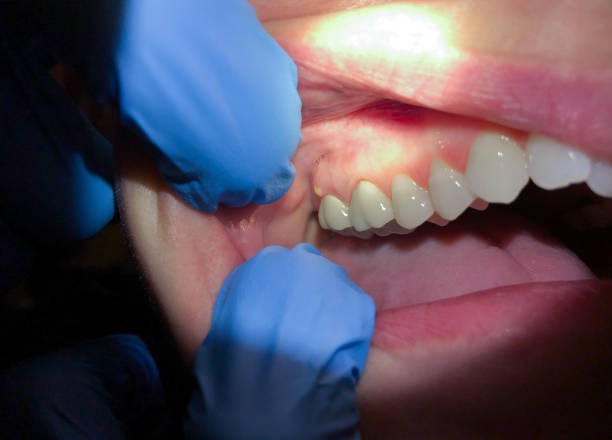 Best Chipped Tooth Repair Near Me  in Thorofare, NJ